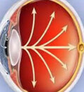 Glaucoma crónico de ángulo abierto.jpg.jpg